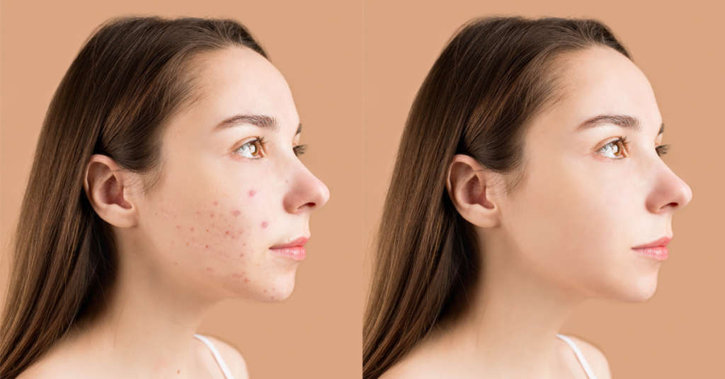 Spot healing in a model